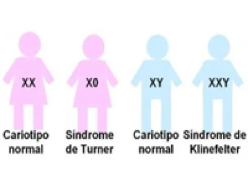 Representacion del Sindrome de Klinefelter