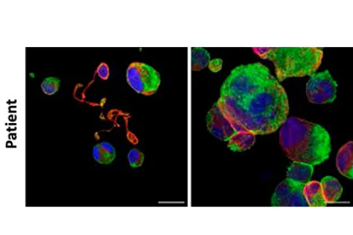 Imagen microscopica de trombocitopenia